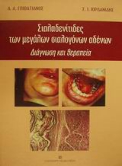 Εικόνα Σιαλαδενίτιδες των μεγάλων σιαλογόνων αδένων