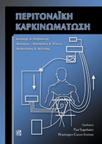 Εικόνα Περιτοναϊκή καρκινομάτωση