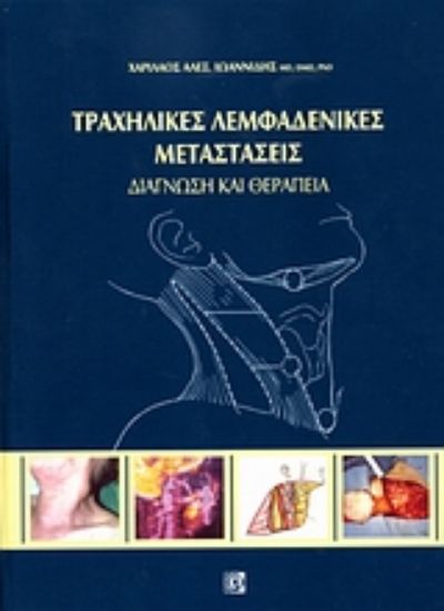 Εικόνα Τραχηλικές λεμφαδενικές μεταστάσεις