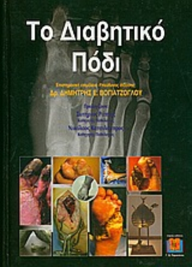 Εικόνα Το διαβητικό πόδι