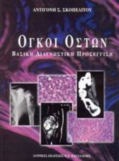 Εικόνα Όγκοι οστών